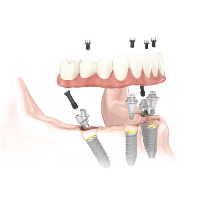 All-On-4 Procedure by Tagle & Castillo Cosmetic & Family Dentistry in McAllen, TX