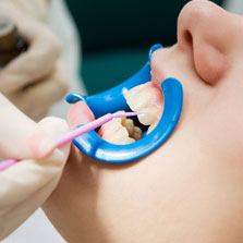 Dental Bonding Restorations offered by Tagle & Castillo Cosmetic & Family Dentistry in McAllen, TX